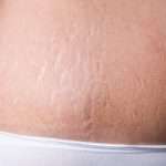 female-belly-with-stretch-marks-closeup-picture-id489668558