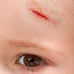 Physical injury blood wound skin human child pain