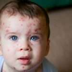 young-toddler-with-chickenpox-picture-id1068794940